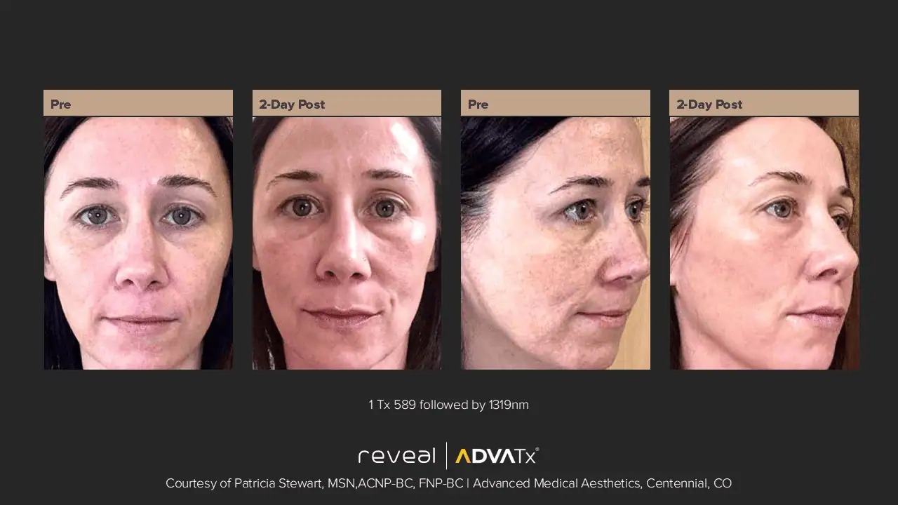 ADVATx BA | Corpus Christi, TX | Coastal Glo Med Spa