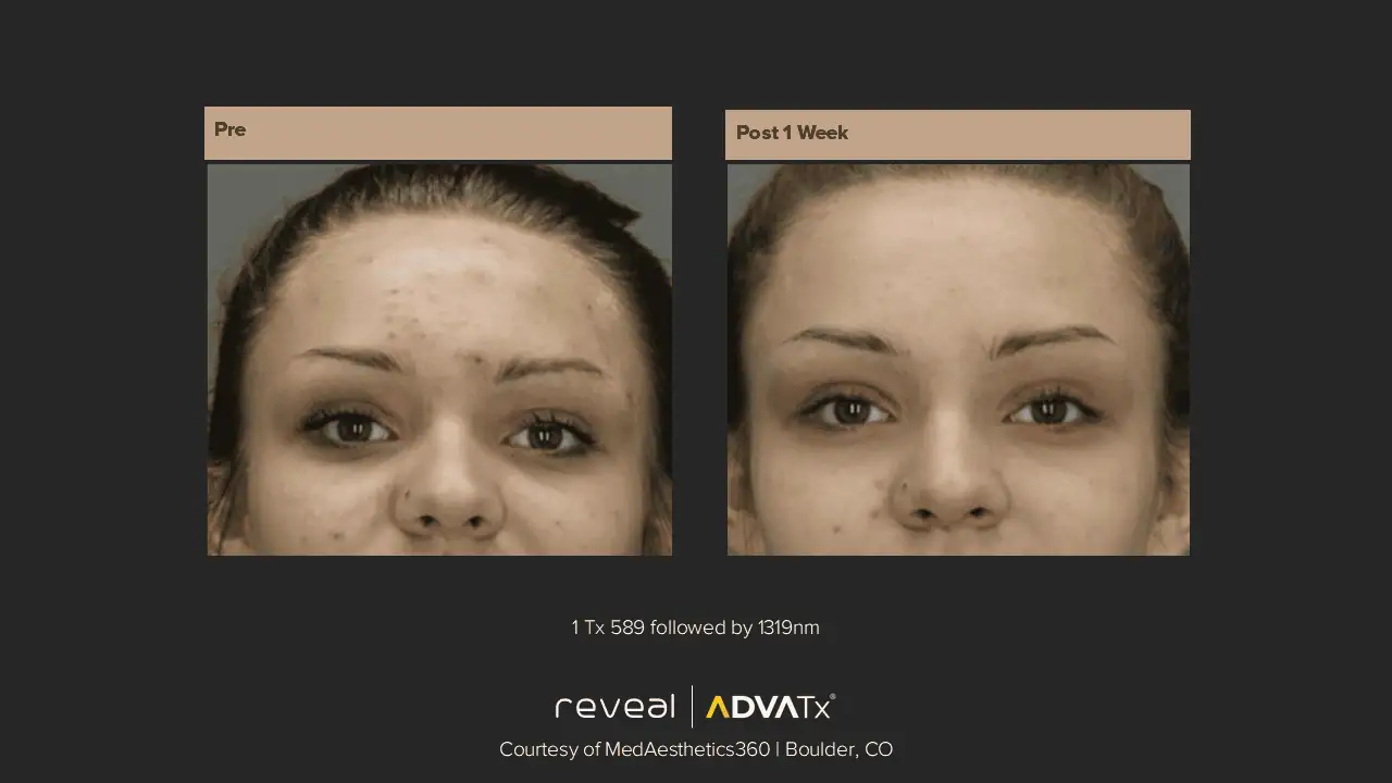 ADVATx | Corpus Christi, TX | Coastal Glo Med Spa