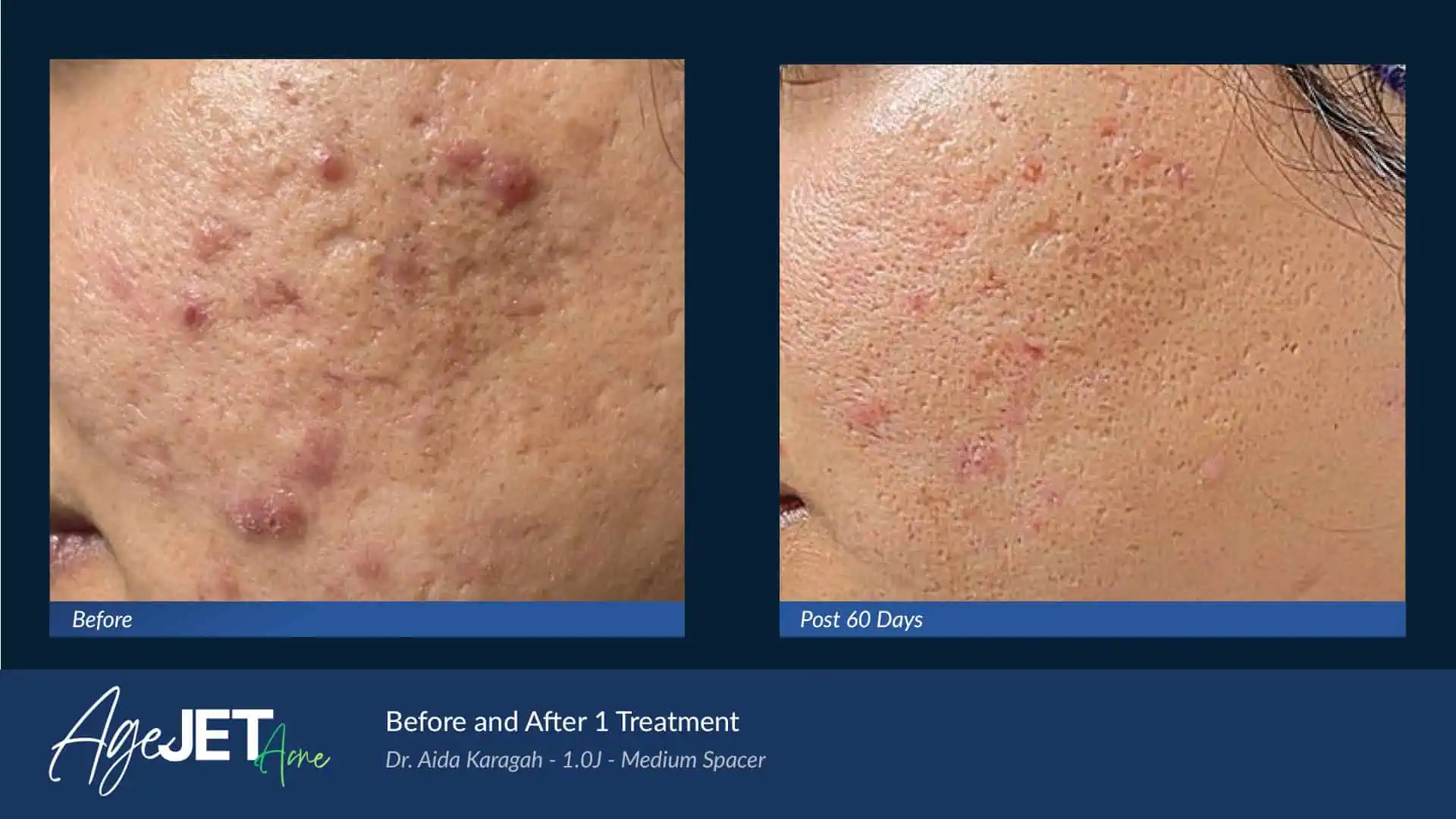 BA AgeJet Acne Femaie Karagah | Corpus Christi, TX | Coastal Glo Med Spa