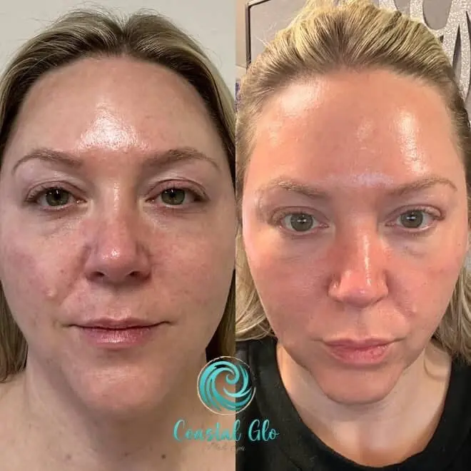 Before and after comparison showing facial aesthetic changes | Medical Spa in Corpus Christi, TX | Coastal Glo