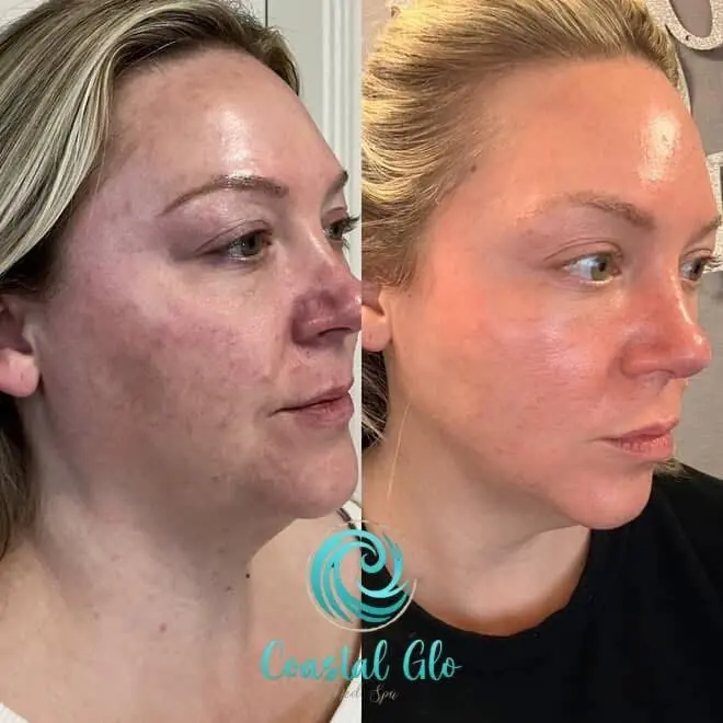 Patient facial before and after AgeJet injector cosmetic results | Medical Spa in Corpus Christi, TX | Coastal Glo