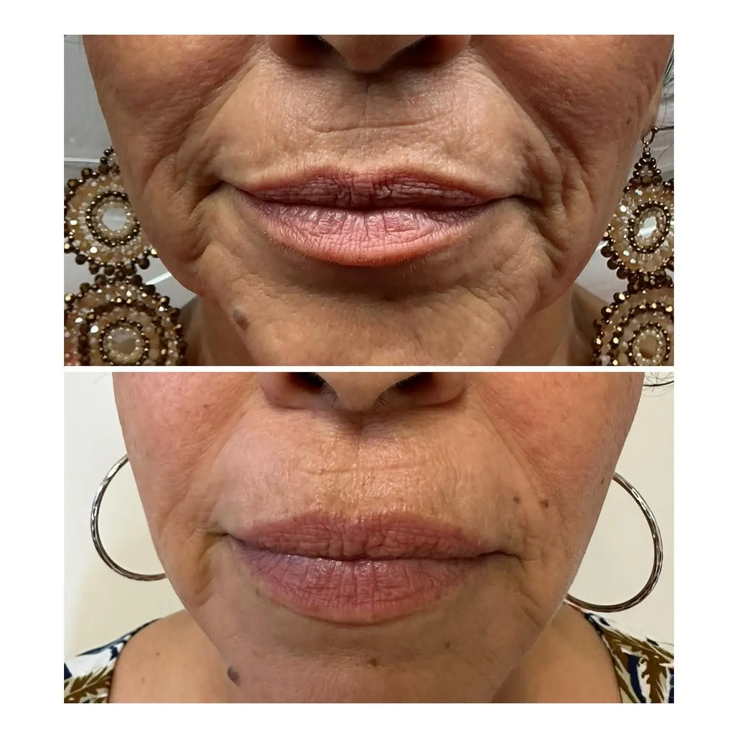 Facial skin appearance before and after non-surgical AgeJet treatment | Medical Spa in Corpus Christi, TX | Coastal Glo