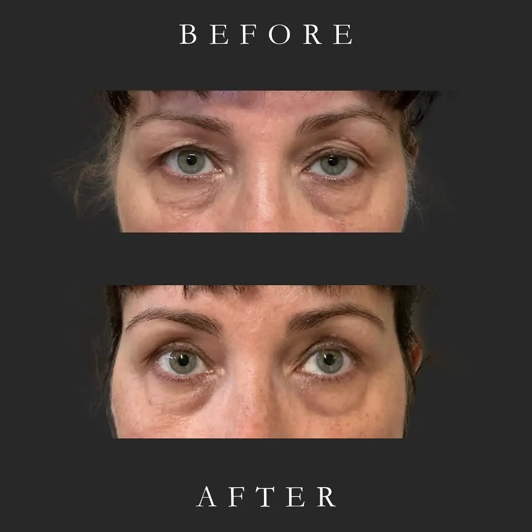 Before and after comparison showing facial skin changes after AgeJet treatment | Medical Spa in Corpus Christi, TX | Coastal Glo