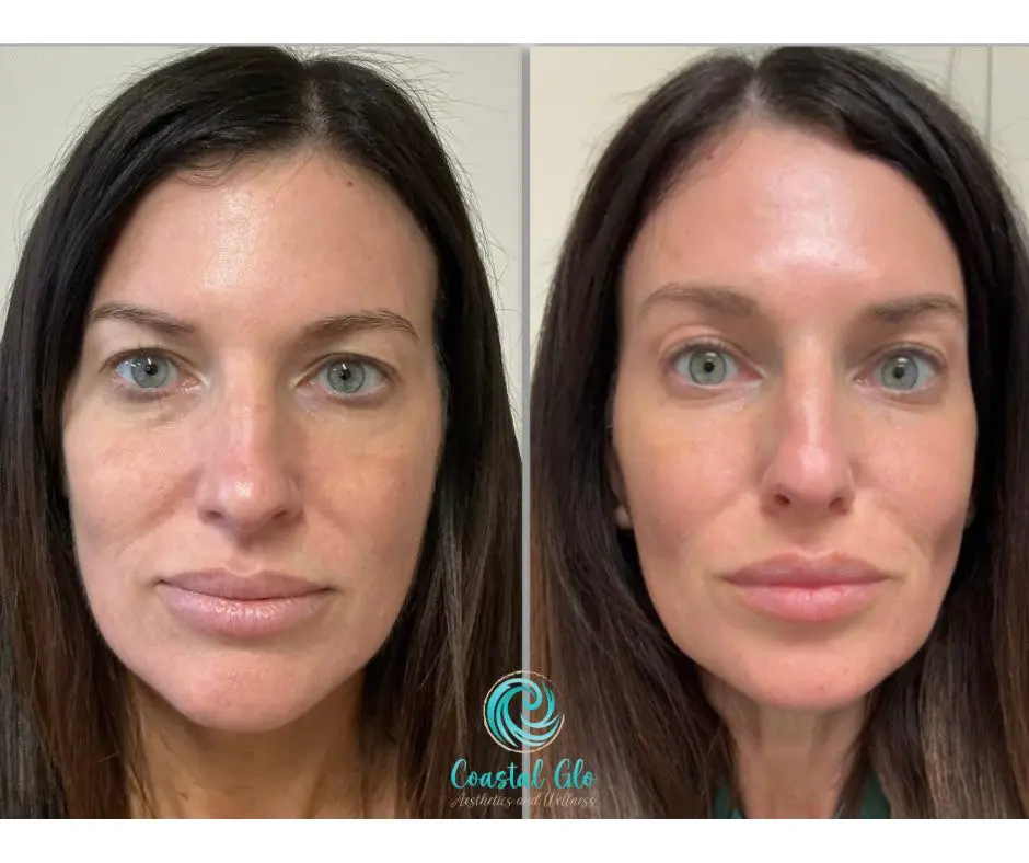 Before and after comparison showing facial skin changes after AgeJet treatment | Medical Spa in Corpus Christi, TX | Coastal Glo